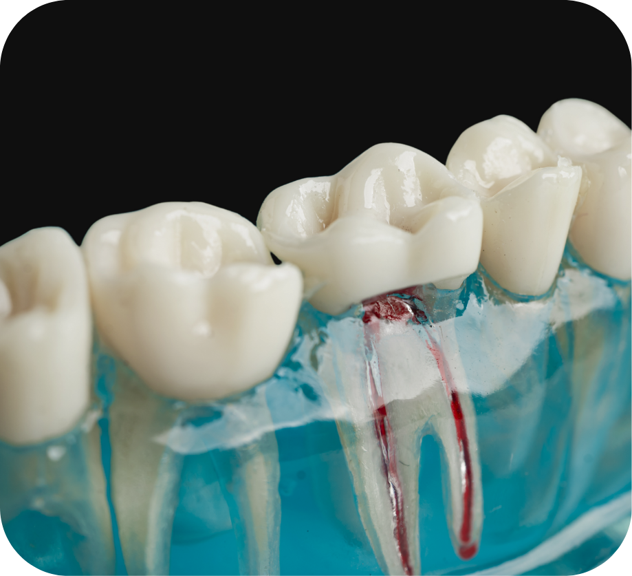 علاجات جذور الأسنان